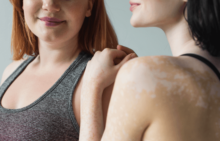 Vitiligo. ¿Qué es y cómo cuidar la piel?