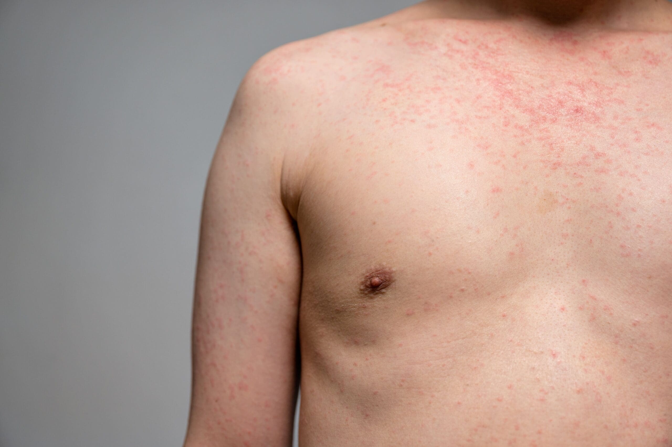 Brote en la piel por calor: cómo prevenirlo con rutinas de cuidado